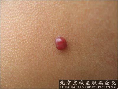 北京那家医院看血管瘤好
