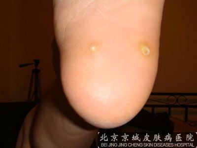 治疗跖疣要多少钱