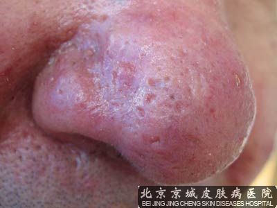 酒糟鼻怎么去红