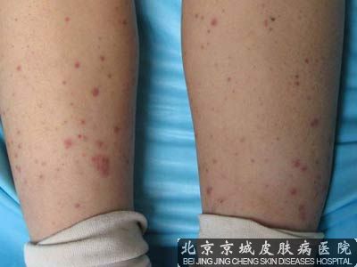 过敏性紫癜反复发做该怎么办