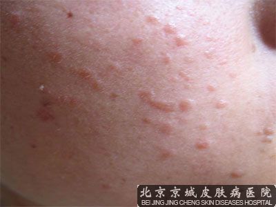 病毒软疣的治疗方法