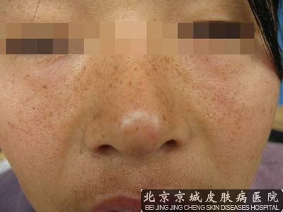 脸上有麻子怎么除掉